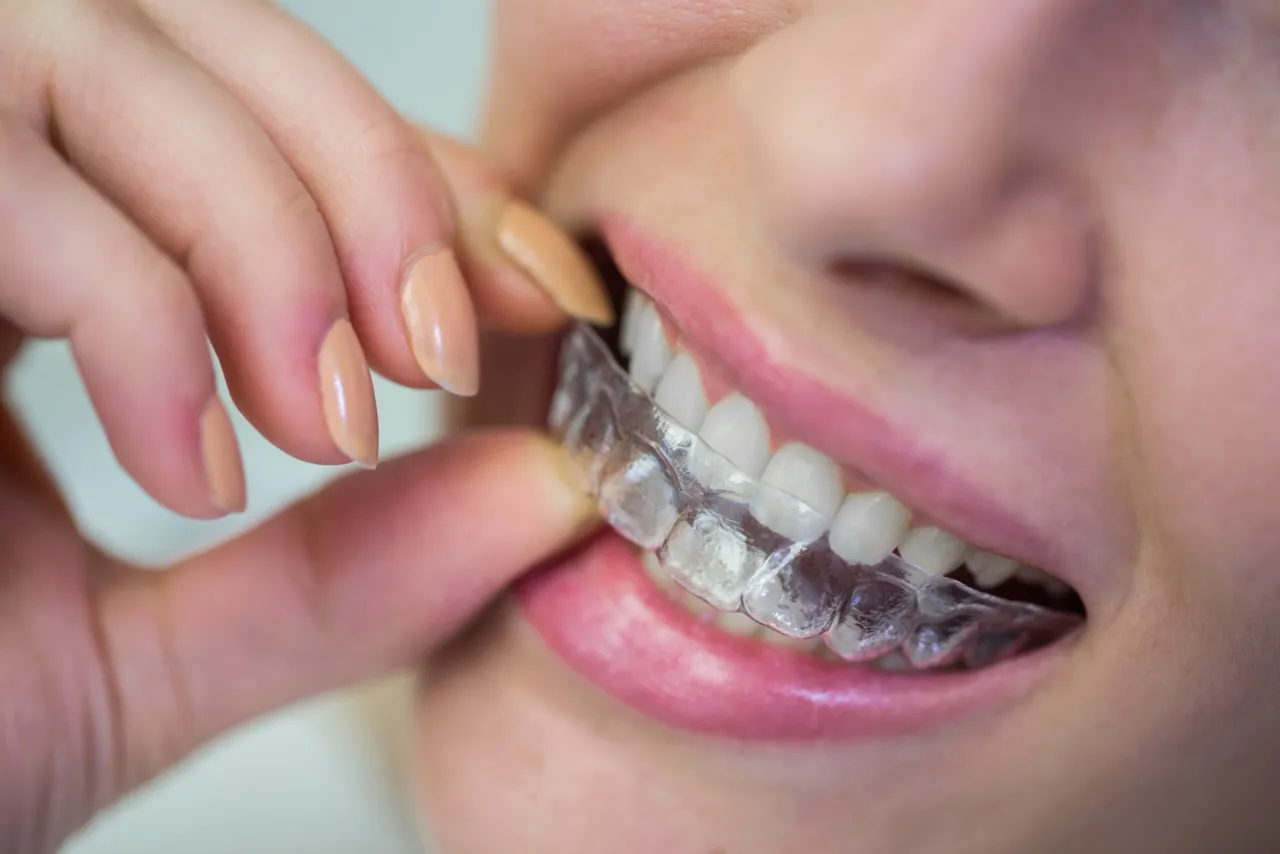 How Invisalign Clear Aligners Work